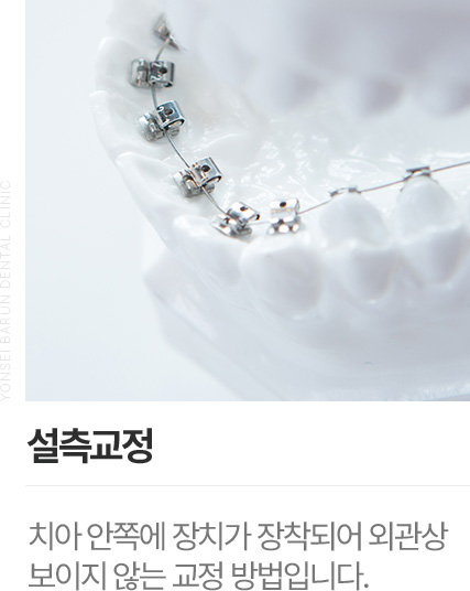 인비절라인 (투명교정)/인비절라인퍼스트