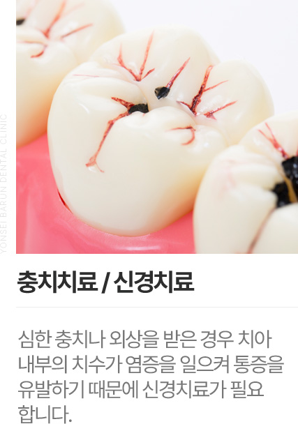 충치치료/신경치료
