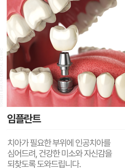 임플란트