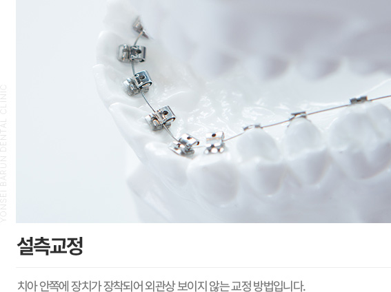 인비절라인 (투명교정)/인비절라인퍼스트