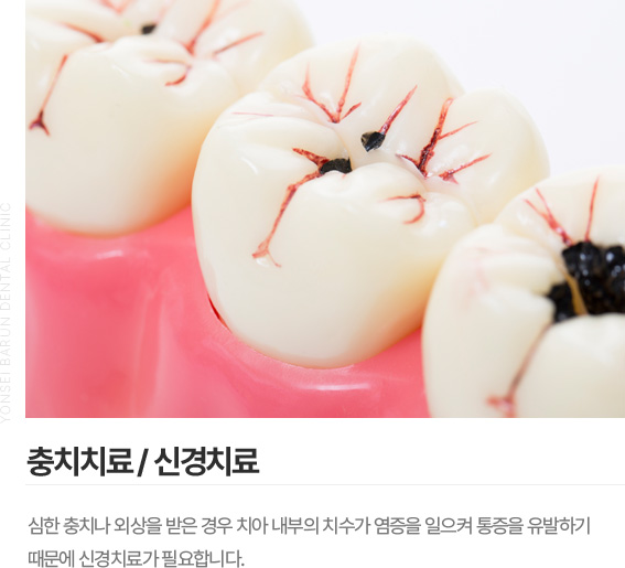 충치치료/신경치료